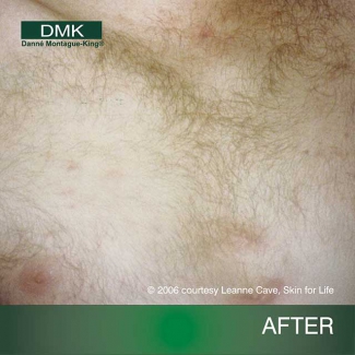 acne03aft - Skin + Wax Clinic